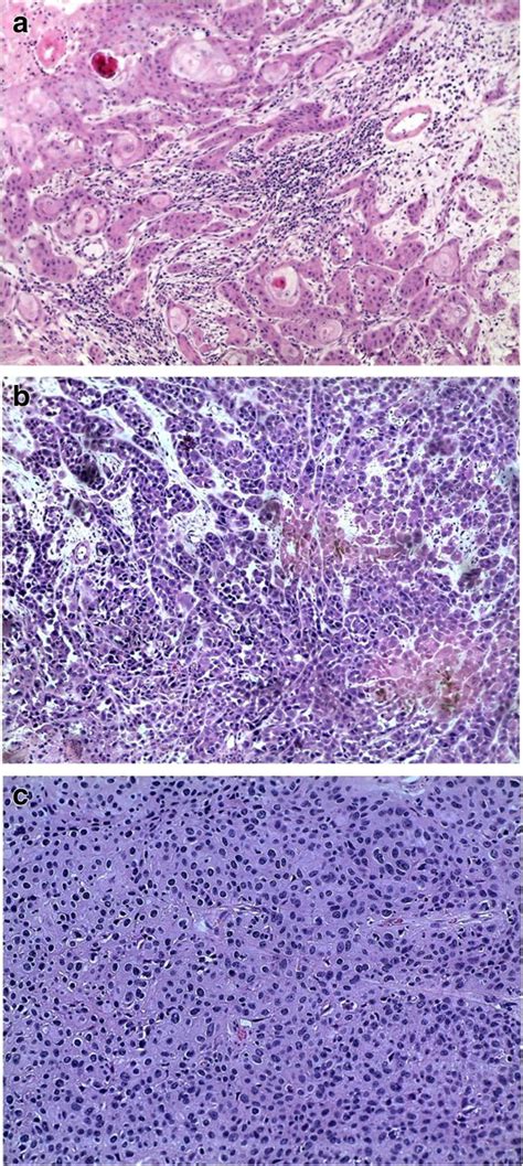 Haematoxylin And Eosin Staining A Grade I Sccc X 10 Neoplasm Download Scientific Diagram