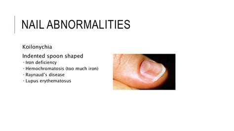 Nail Abnormalities