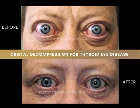 Thyroid Eye Disease Photos Plastic Eye Surgery Associates