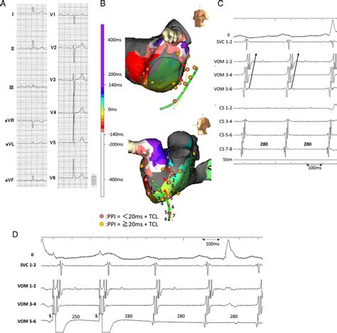 A The 12 Lead Surface Electrocardiogram During Atrial Tachycardia