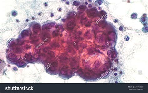 Malignant Effusion Pleural Fluid Cytology Lung Stock Photo 548003581 ...