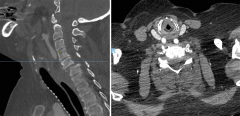 Contrast Enhanced CT Scan Of The Cervical Spine Showing C5C6 Fracture