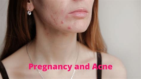 Pregnancy and Acne – SpeciallyMe®