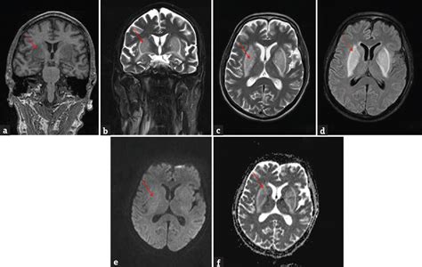 Acute Generalized Chorea As Presenting Manifestation Of Uremic