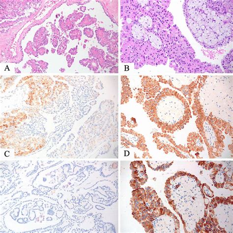 Tfe Rearranged Renal Cell Carcinoma With Papillary Architecture A