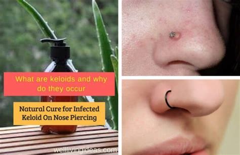 Keloid Scar From Nose Piercing