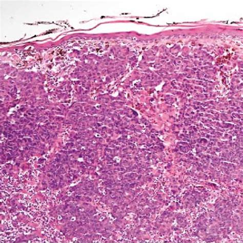 (PDF) Malignant Melanoma – from Classical Histology towards Molecular ...