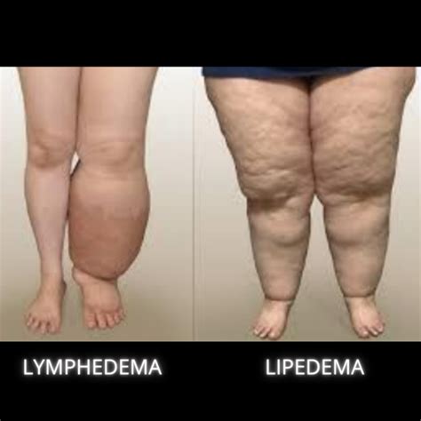 Lymphedema And Lipedema Treatment Wound Institute