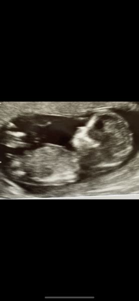 Week Scan Baby Gender Guesses Mumsnet