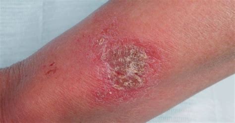 Virtual Grand Rounds In Dermatology 20 Fitbit Dermatitis