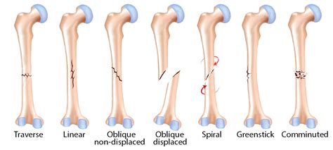 Common Fractures Mmd Chiropractic Health Centre