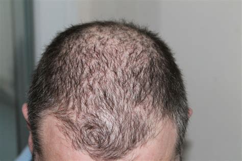 What Is Pluggy Hair Transplant Causes And Treatments