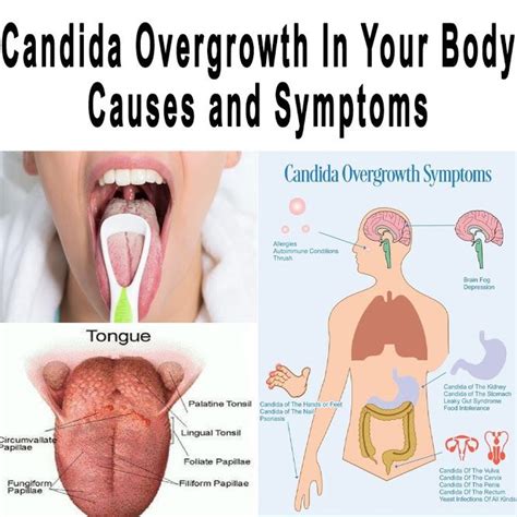 Candida Overgrowth In Your Body Causes And Symptoms Candida