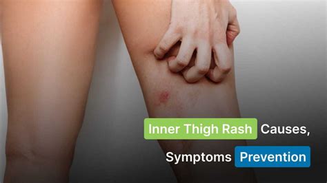 Inner Thigh Rash Causes Symptoms And Prevention Stay Healthy And Active Your Health Guide