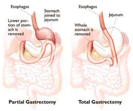 Total Gastrectomy For Stomach Cancer