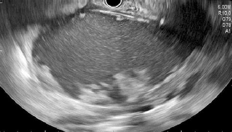 Walled Off Pancreatic Necrosis Visualized During Endoscopic Ultrasound