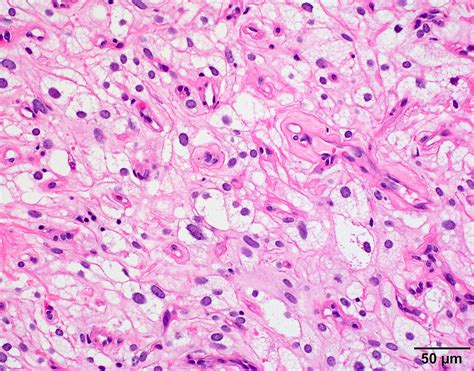 Meningioma Histology