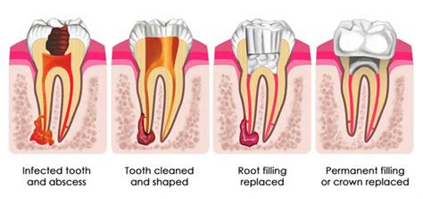 Root canal pain a week later