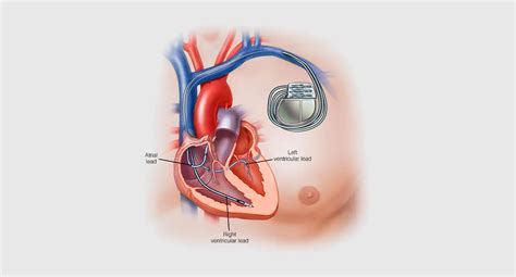 Best Cardiologist Doctor In Fortis Hospital Delhi Ncr Dr Naresh Kumar Goyal