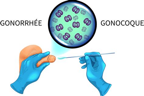 Gonococcie Causes Symptômes et Traitements Information