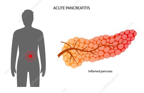 Acute Pancreatitis Illustration Stock Image F Science