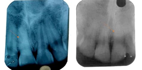 Pulpal Calcification Seen In Maxillary Right Central Incisor Widening