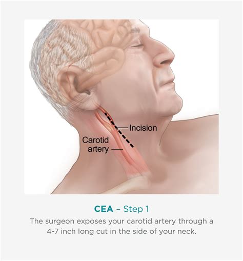 Blocked Carotid Artery Surgery Recovery Mapametawan