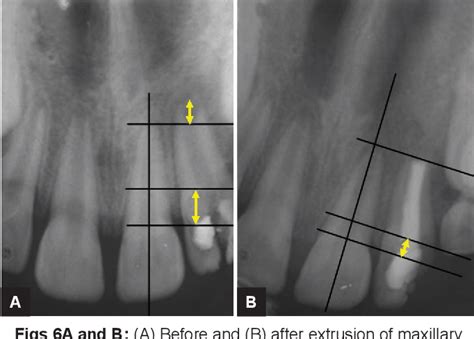 Figure 6 From A Novel Approach To Extrude Subgingivally Fractured Tooth Using Customized