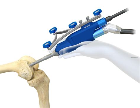 Best Robotic Knee Replacement Surgery Hospitals In Vijayawada Srikara