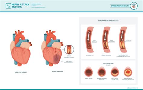 Coronary Artery Disease: Causes, Symptoms, and Treatments Explained