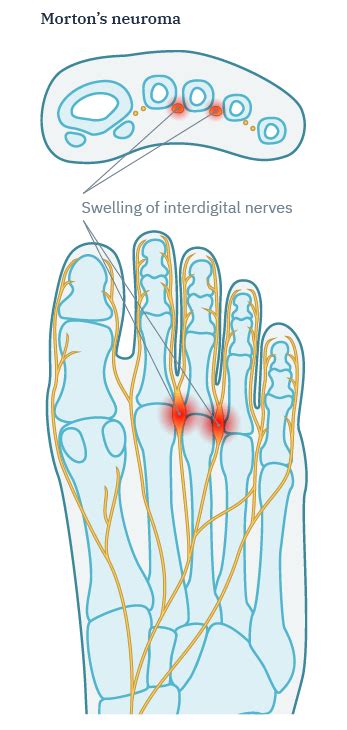 Mortons Neuroma Interdigital Neuroma Bursal Neuroma Complex