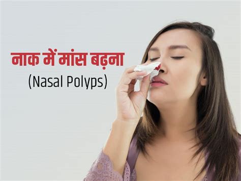 Nasal Polyps Causes नाक में मांस बढ़ने पर दिखाई देते हैं ये 10 लक्षण