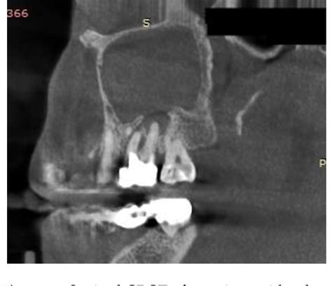 Figure 4 From Role Of Endoscopic Sinus Surgery And Dental Treatment In