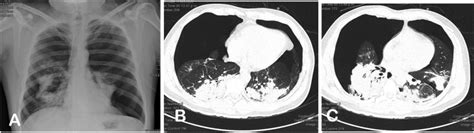 Bilateral Spontaneous Pneumothorax In Sars Cov 2 Infection A Very Rare