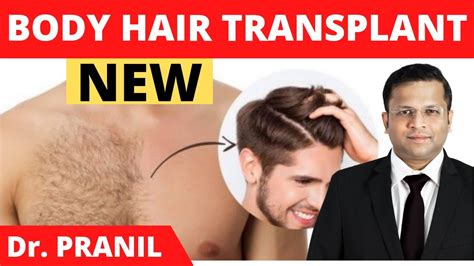 Body Hair Transplant Bht Fully Explained Chest Hair Transplant Results Youtube