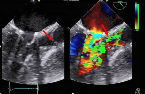 Parasternal Longitudinal Axis Transesophageal Echocardiography Tee Download Scientific