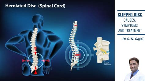 SLIPPED DISC: CAUSES, SYMPTOM & TREATMENT | Dr. G. N. GOYAL