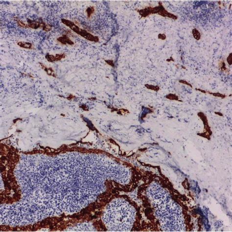 Intense Cytoplasmatic Galectine 3 Immunostaining In Both Warthin Like