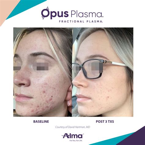 Opus Plasma Before And After 2 Renew Wellness And Aesthetics