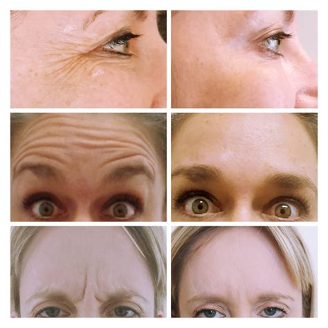 Anti Wrinkle Treatments North Yorkshire Dentist Dentist Leyburn