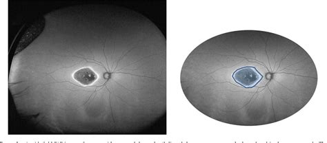 Figure From Wide Field Fundus Autofluorescence Abnormalities And