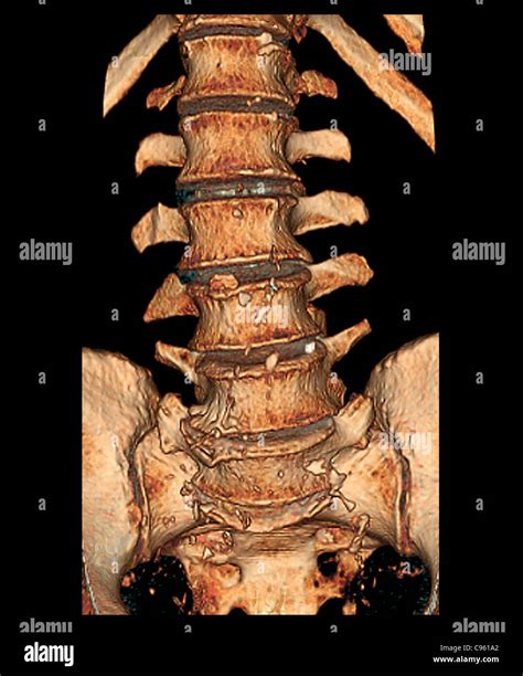 La enfermedad discal degenerativa TC 3D Fotografía de stock Alamy