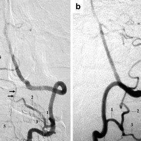 Digital Subtraction Angiography Left Va Anteroposterior View Showing