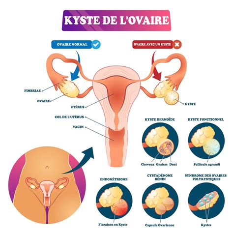 Kyste ovarien quand faut il sinquiéter Information hospitalière