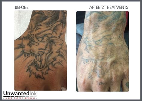 Color Tattoo Removal Before And After - Colorxml