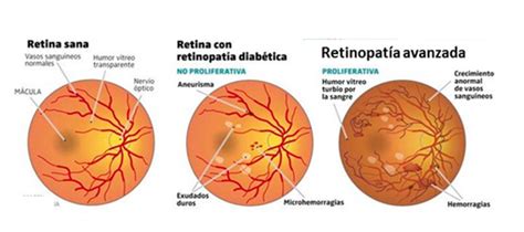 Retinopatía Diabética Lo que usted debe saber para evitar esta