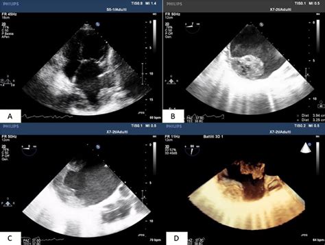 Transthoracic A And Transesophageal B C D Echocardiography