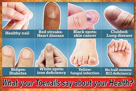 What Your Toenails Say About Your Health Reflective Thoughts