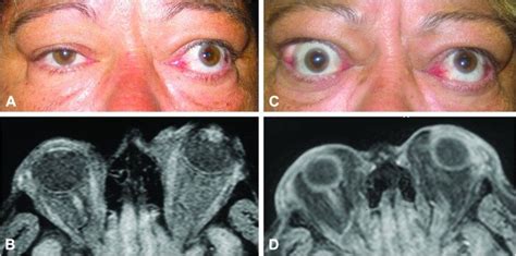 A Patient 2 Thyroid Ophthalmopathy Associated Signs Involving The Download Scientific