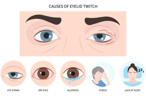 Why Do My Eyes Twitch Causes Of Eye Twitching And How To Manage It Ensocure